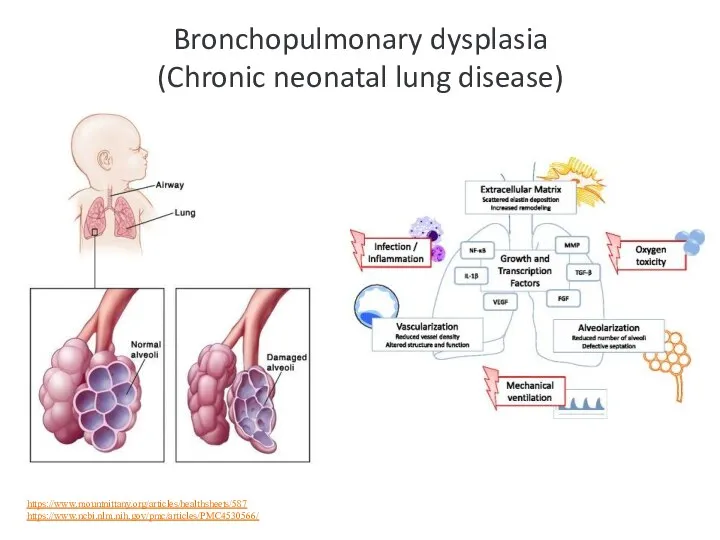 Bronchopulmonary dysplasia (Chronic neonatal lung disease) https://www.mountnittany.org/articles/healthsheets/587 https://www.ncbi.nlm.nih.gov/pmc/articles/PMC4530566/