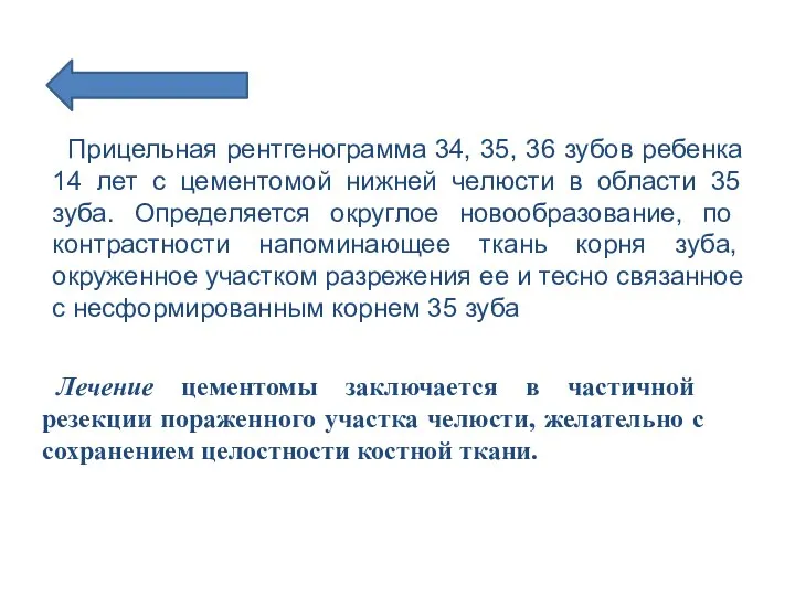 Прицельная рентгенограмма 34, 35, 36 зубов ребенка 14 лет с цементомой