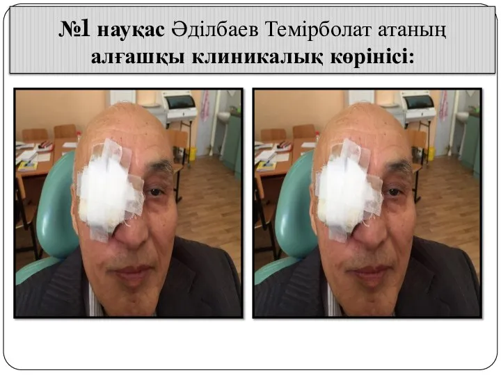 №1 науқас Әділбаев Темірболат атаның алғашқы клиникалық көрінісі: