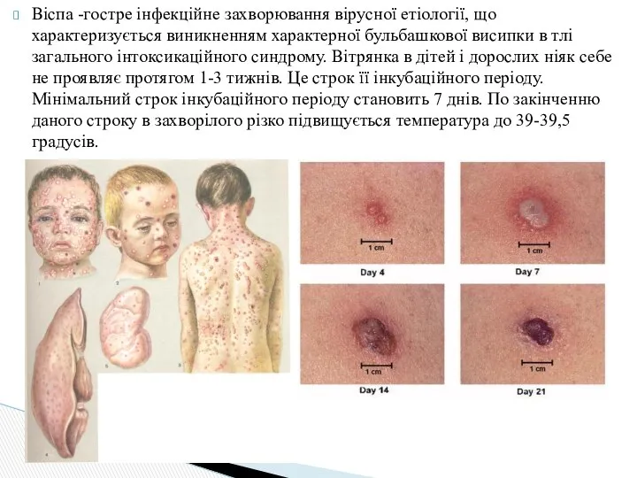 Віспа -гостре інфекційне захворювання вірусної етіології, що характеризується виникненням характерної бульбашкової