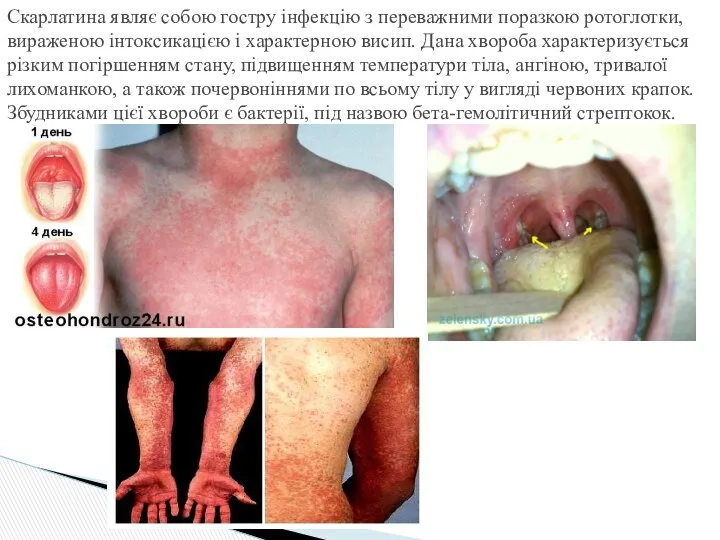 Скарлатина являє собою гостру інфекцію з переважними поразкою ротоглотки, вираженою інтоксикацією