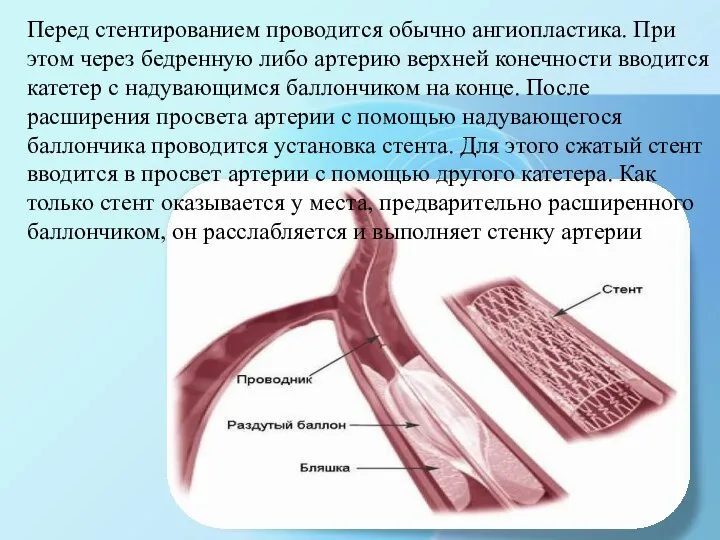 Перед стентированием проводится обычно ангиопластика. При этом через бедренную либо артерию