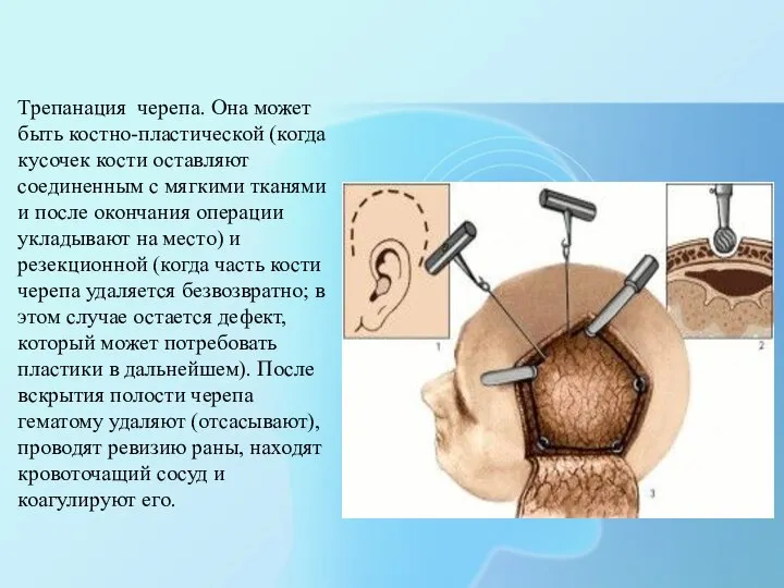 Трепанация черепа. Она может быть костно-пластической (когда кусочек кости оставляют соединенным