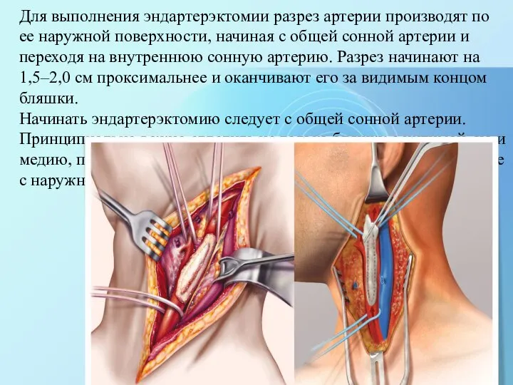 Для выполнения эндартерэктомии разрез артерии производят по ее наружной поверхности, начиная