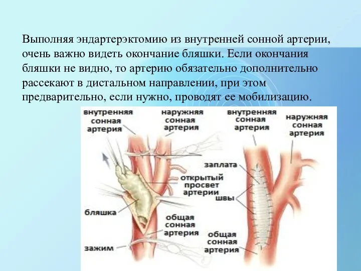 Выполняя эндартерэктомию из внутренней сонной артерии, очень важно видеть окончание бляшки.