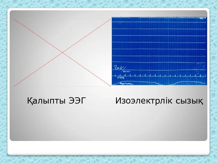 Қалыпты ЭЭГ Изоэлектрлік сызық