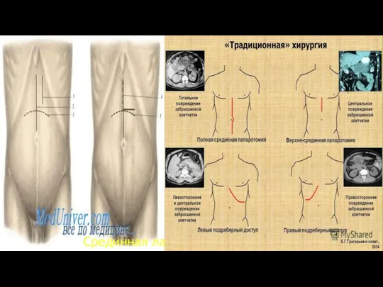 Срединная лапаротомия