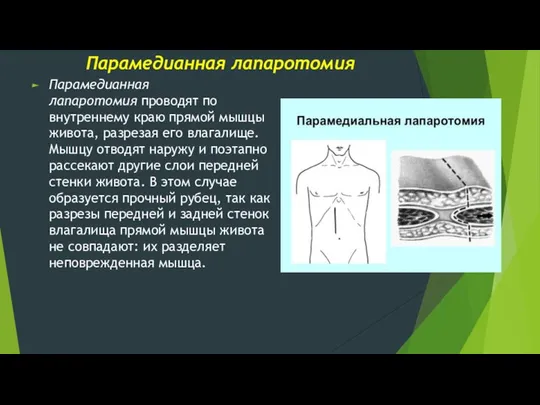 Парамедианная лапаротомия Парамедианная лапаротомия проводят по внутреннему краю прямой мышцы живота,