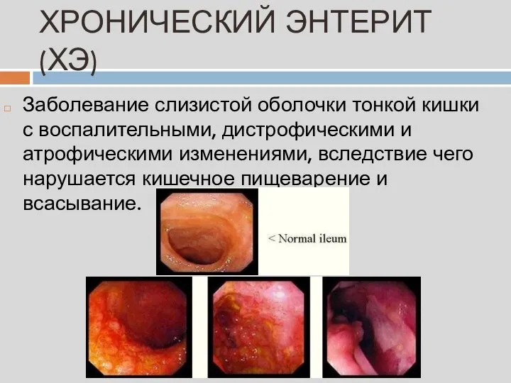 ХРОНИЧЕСКИЙ ЭНТЕРИТ (ХЭ) Заболевание слизистой оболочки тонкой кишки с воспалительными, дистрофическими