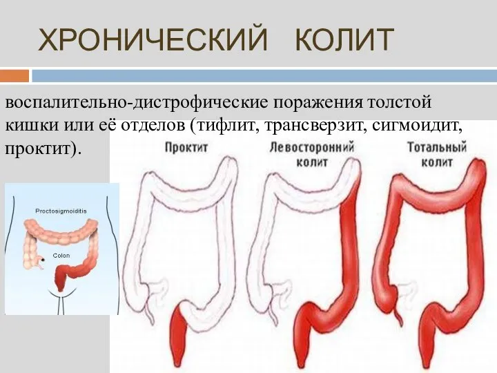 ХРОНИЧЕСКИЙ КОЛИТ воспалительно-дистрофические поражения толстой кишки или её отделов (тифлит, трансверзит, сигмоидит, проктит).