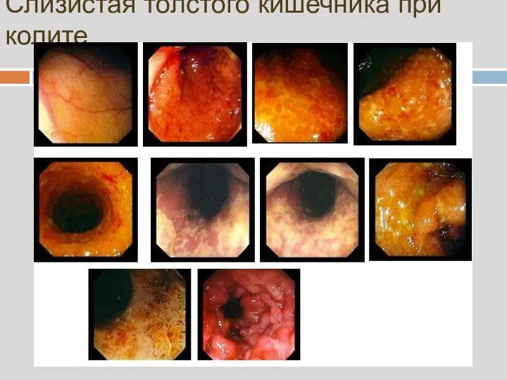 Слизистая толстого кишечника при колите