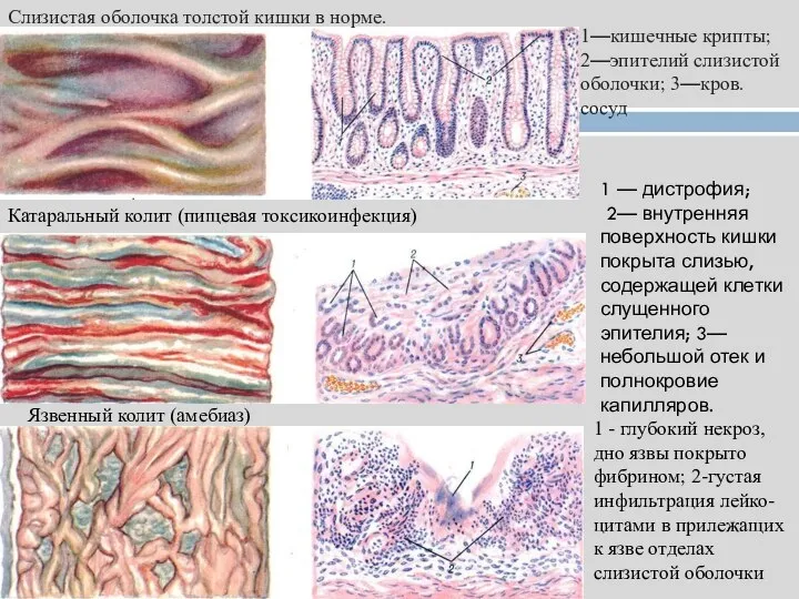Слизистая оболочка толстой кишки в норме. 1—кишечные крипты; 2—эпителий слизистой оболочки;