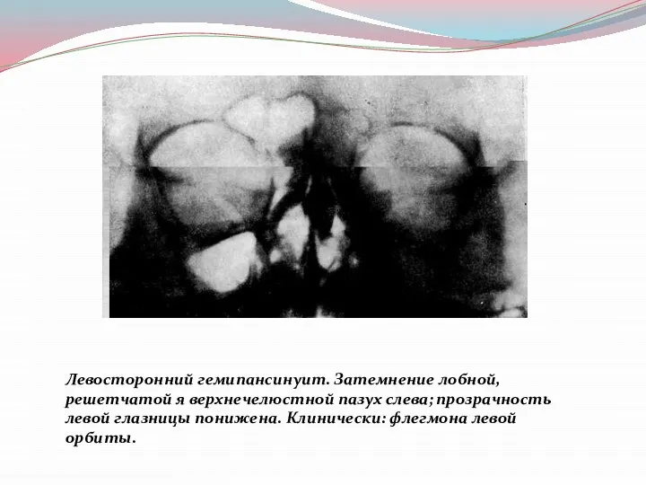 Левосторонний гемипансинуит. Затемнение лобной, решетчатой я верхнечелюстной пазух слева; прозрачность левой