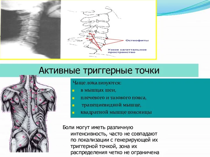 Активные триггерные точки Чаще локализуются: в мышцах шеи, плечевого и тазового