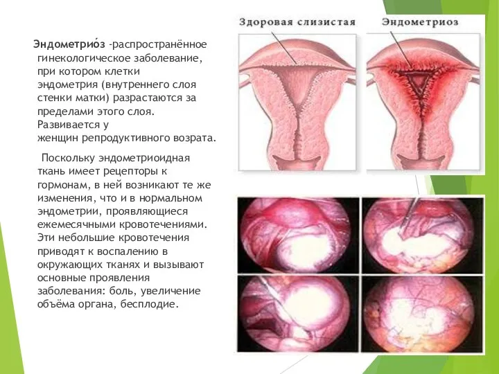 Эндометрио́з -распространённое гинекологическое заболевание, при котором клетки эндометрия (внутреннего слоя стенки