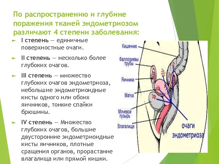 По распространению и глубине поражения тканей эндометриозом различают 4 степени заболевания: