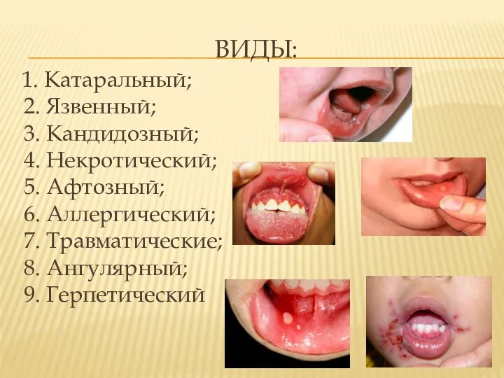 ВИДЫ: 1. Катаральный; 2. Язвенный; 3. Кандидозный; 4. Некротический; 5. Афтозный;