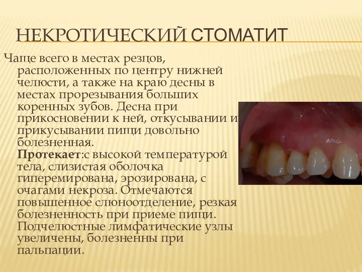 Чаще всего в местах резцов, расположенных по центру нижней челюсти, а