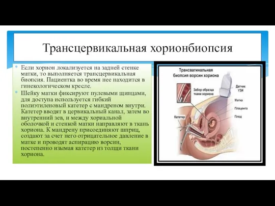 Если хорион локализуется на задней стенке матки, то выполняется трансцервикальная биопсия.