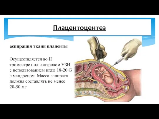 аспирация ткани плаценты Осуществляется во II триместре под контролем УЗИ с