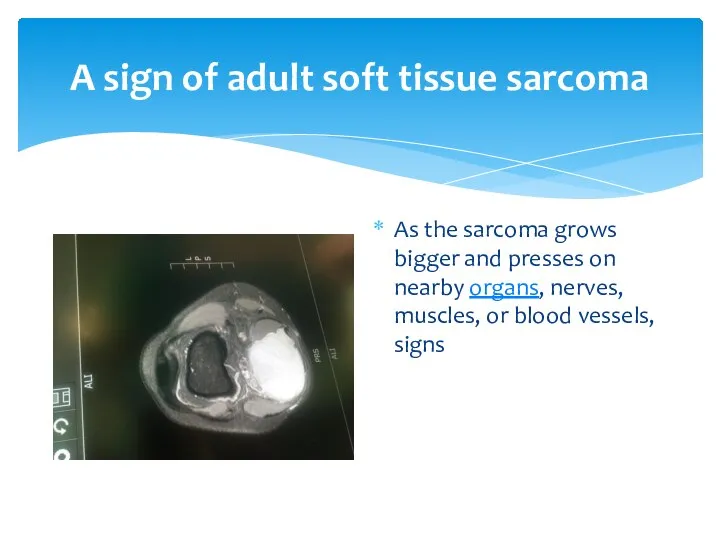 A sign of adult soft tissue sarcoma As the sarcoma grows