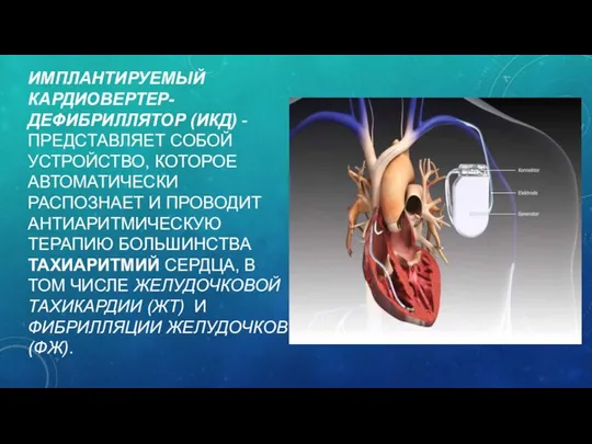 ИМПЛАНТИРУЕМЫЙ КАРДИОВЕРТЕР-ДЕФИБРИЛЛЯТОР (ИКД) - ПРЕДСТАВЛЯЕТ СОБОЙ УСТРОЙСТВО, КОТОРОЕ АВТОМАТИЧЕСКИ РАСПОЗНАЕТ И