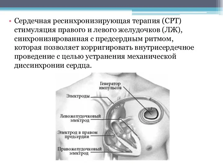 Сердечная ресинхронизирующая терапия (СРТ) стимуляция правого и левого желудочков (ЛЖ), синхронизированная