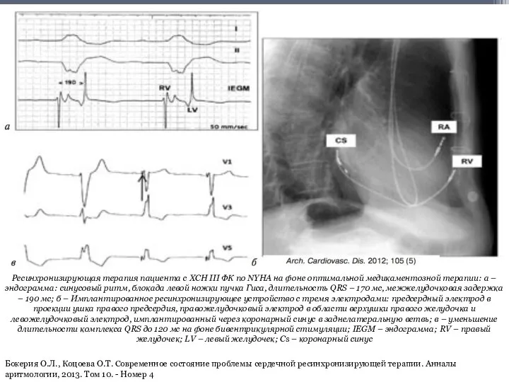 Ресинхронизирующая терапия пациента с ХСН III ФК по NYHA на фоне