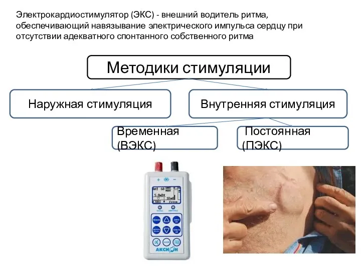 Методики стимуляции Наружная стимуляция Внутренняя стимуляция Временная (ВЭКС) Постоянная (ПЭКС) Электрокардиостимулятор