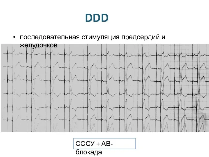 DDD последовательная стимуляция предсердий и желудочков СССУ + АВ-блокада