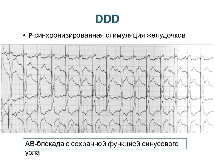 DDD P-синхронизированная стимуляция желудочков АВ-блокада с сохранной функцией синусового узла