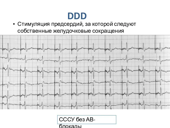 DDD Стимуляция предсердий, за которой следуют собственные желудочковые сокращения СССУ без АВ-блокады