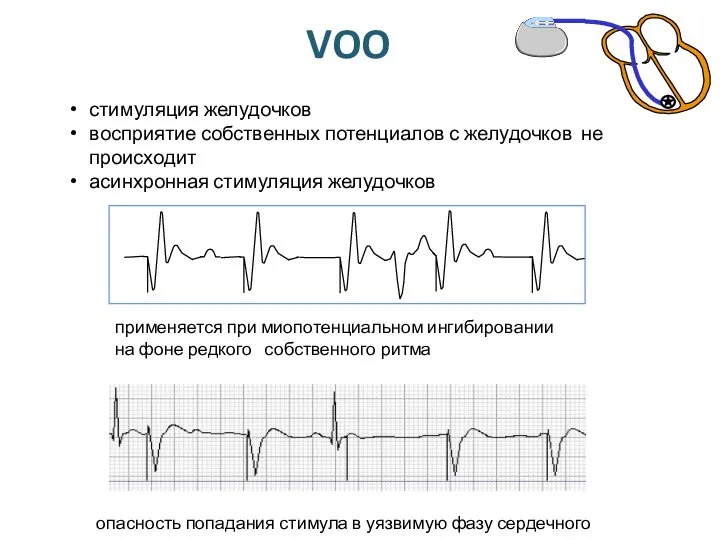 VOO стимуляция желудочков восприятие собственных потенциалов с желудочков не происходит асинхронная