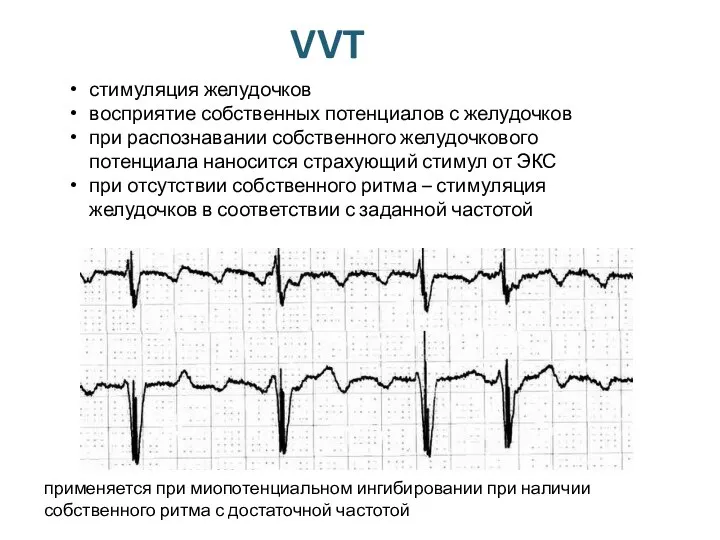 VVT стимуляция желудочков восприятие собственных потенциалов с желудочков при распознавании собственного