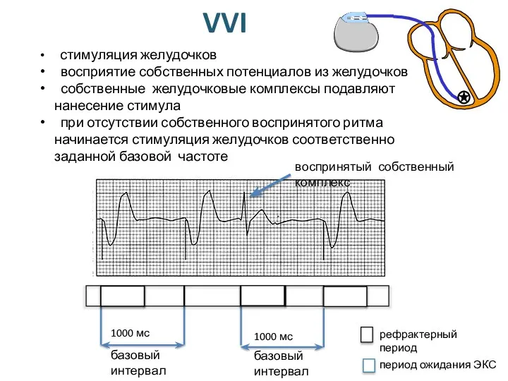 VVI стимуляция желудочков восприятие собственных потенциалов из желудочков собственные желудочковые комплексы