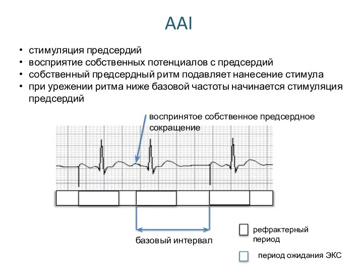 AAI стимуляция предсердий восприятие собственных потенциалов с предсердий собственный предсердный ритм