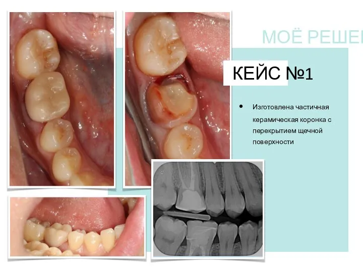 КЕЙС №1 Изготовлена частичная керамическая коронка с перекрытием щечной поверхности МОЁ РЕШЕНИЕ