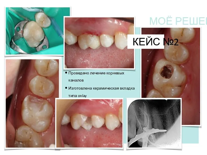 КЕЙС №2 Проведено лечение корневых каналов Изготовлена керамическая вкладка типа onlay МОЁ РЕШЕНИЕ
