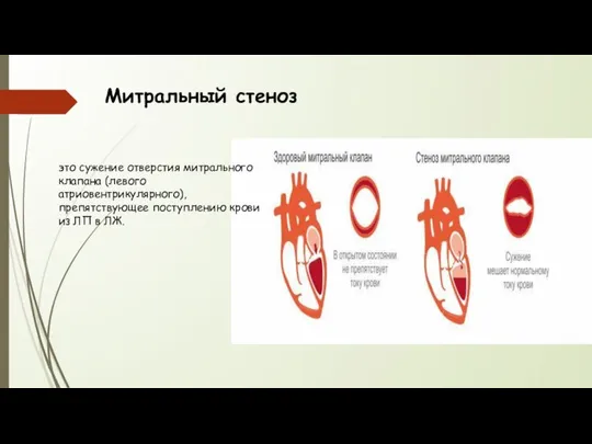 Митральный стеноз это сужение отверстия митрального клапана (левого атриовентрикулярного), препятствующее поступлению крови из ЛП в ЛЖ.