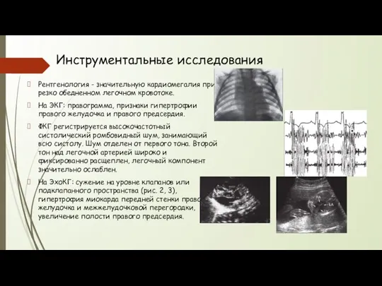 Инструментальные исследования Рентгенология - значительную кардиомегалия при резко обедненном легочном кровотоке.