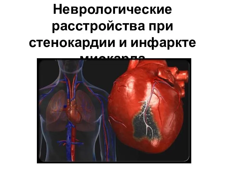 Неврологические расстройства при стенокардии и инфаркте миокарда