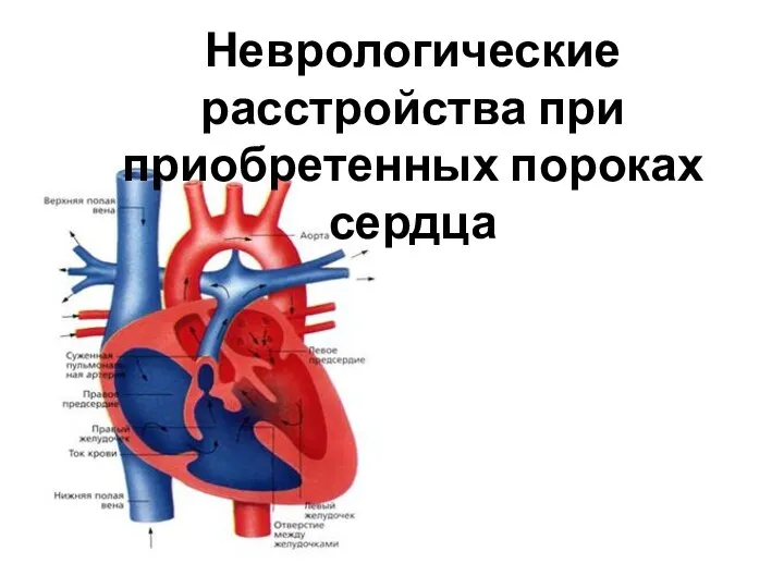 Неврологические расстройства при приобретенных пороках сердца