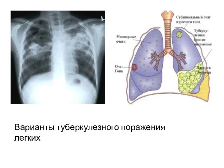 Варианты туберкулезного поражения легких