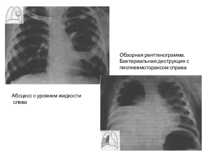 Абсцесс с уровнем жидкости слева Обзорная рентгенограмма. Бактериальная деструкция с пиопневмотораксом справа