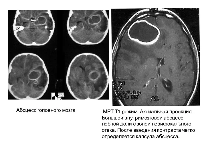 Абсцесс головного мозга МРТ Т1-режим. Аксиальная проекция. Большой внутримозговой абсцесс лобной