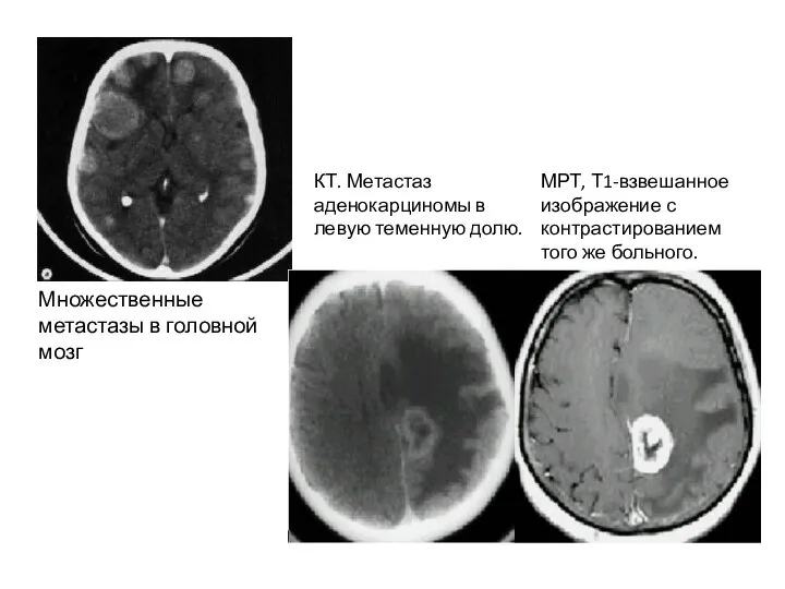 КТ. Метастаз аденокарциномы в левую теменную долю. МРТ, Т1-взвешанное изображение с