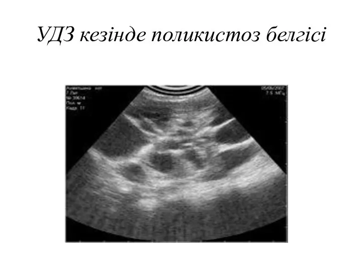 УДЗ кезінде поликистоз белгісі