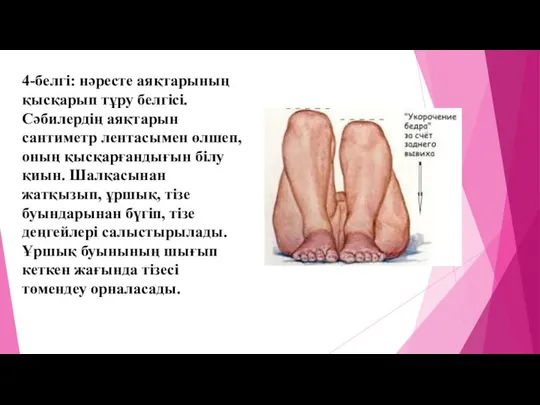 4-белгі: нәресте аяқтарының қысқарып тұру белгісі. Сәбилердің аяқтарын сантиметр лентасымен өлшеп,