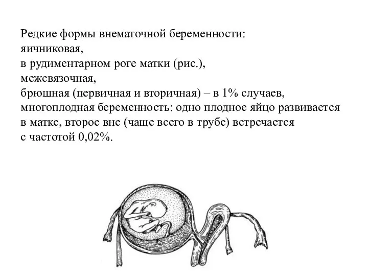 Редкие формы внематочной беременности: яичниковая, в рудиментарном роге матки (рис.), межсвязочная,