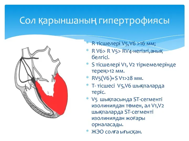 R тісшелері V5,V6 >16 мм; R V6> R V5> RV4-негізгі,анық белгісі.